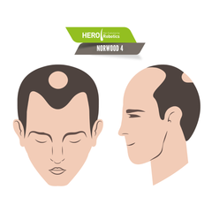 Understanding Norwood Level 4 Hair Loss in 2024