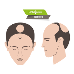 Norwood Level 5 Hair Loss in 2024: Exploring Restoration Solutions