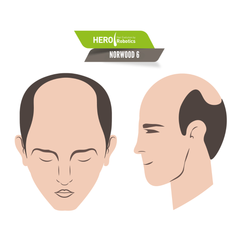 Signs of Norwood Level 6 Hair Loss in 2024