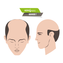 Norwood Level 7 Hair Loss in 2024: Restoring Hope