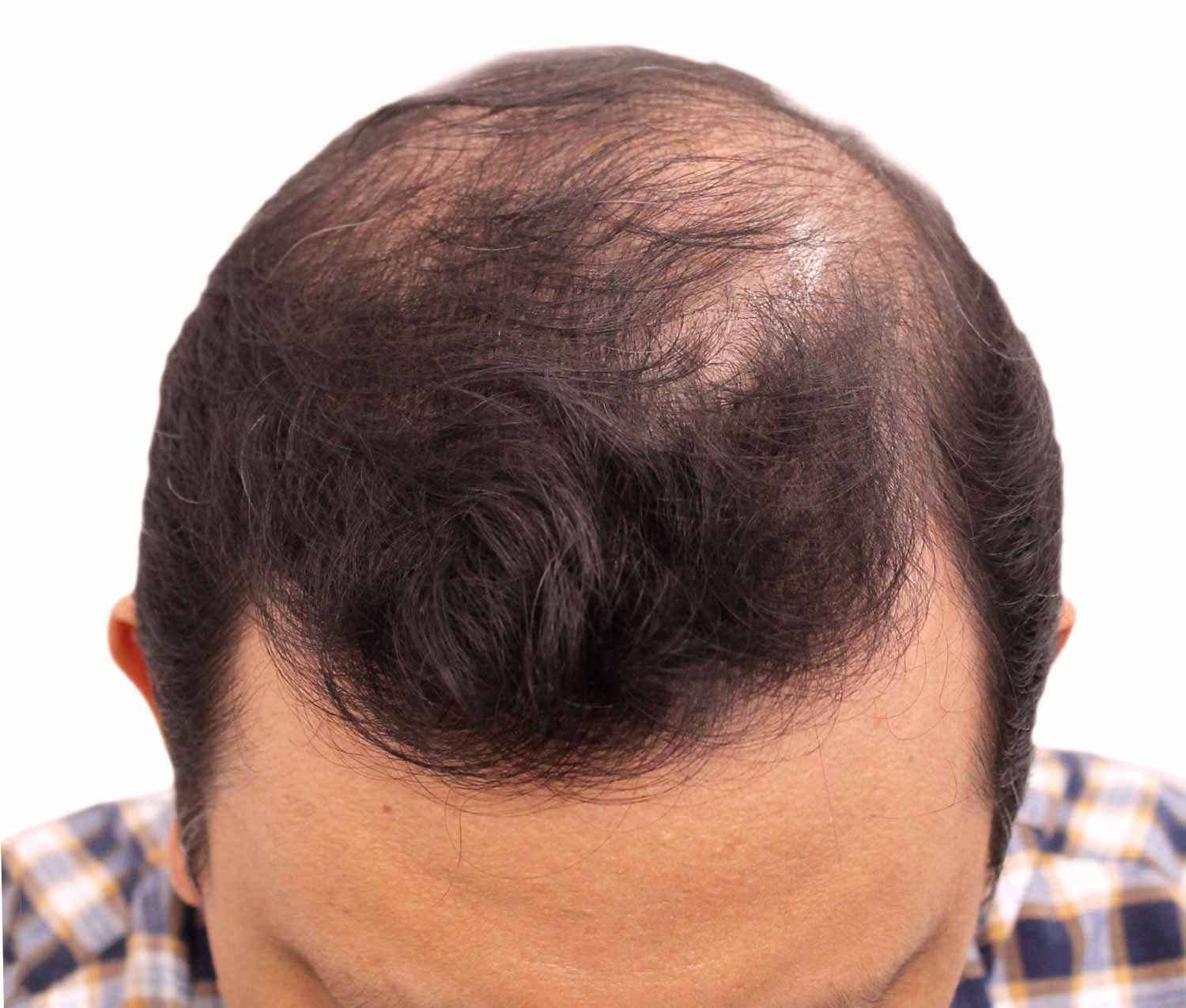 Before hair restoration | Real patient, results may vary per individual