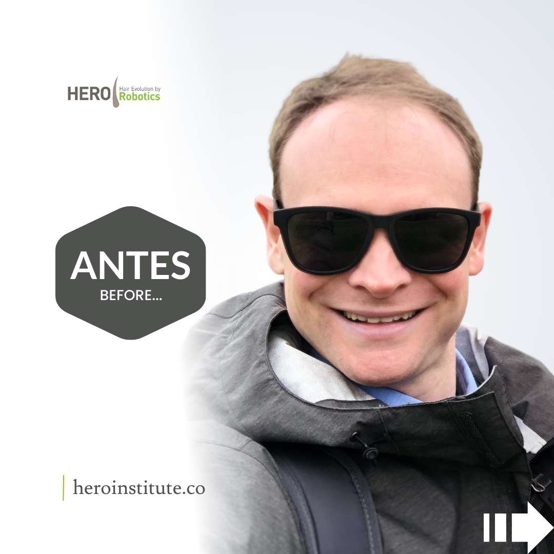 Hair Transplant RESULTS | Real Patient... Real Results