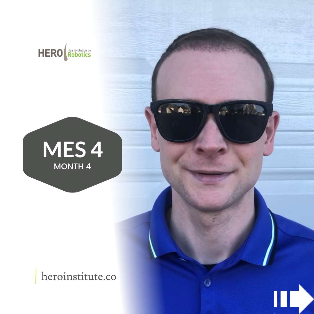 Hair Transplant RESULTS | Real Patient... Real Results