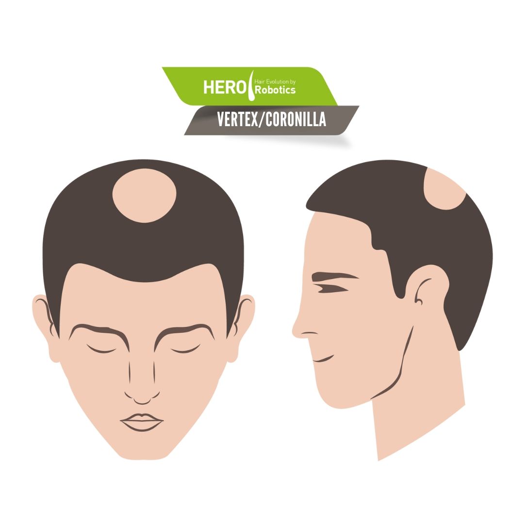 Alopecia en el Vértice: Causas y Tratamientos para la Pérdida de Cabello en la Coronilla