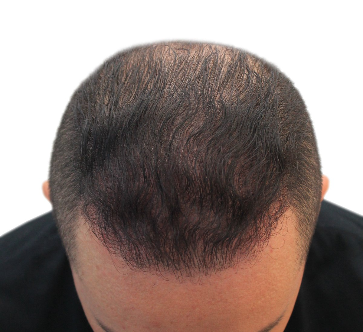 male-full-hair-restoration-HERO-hair-Institute
