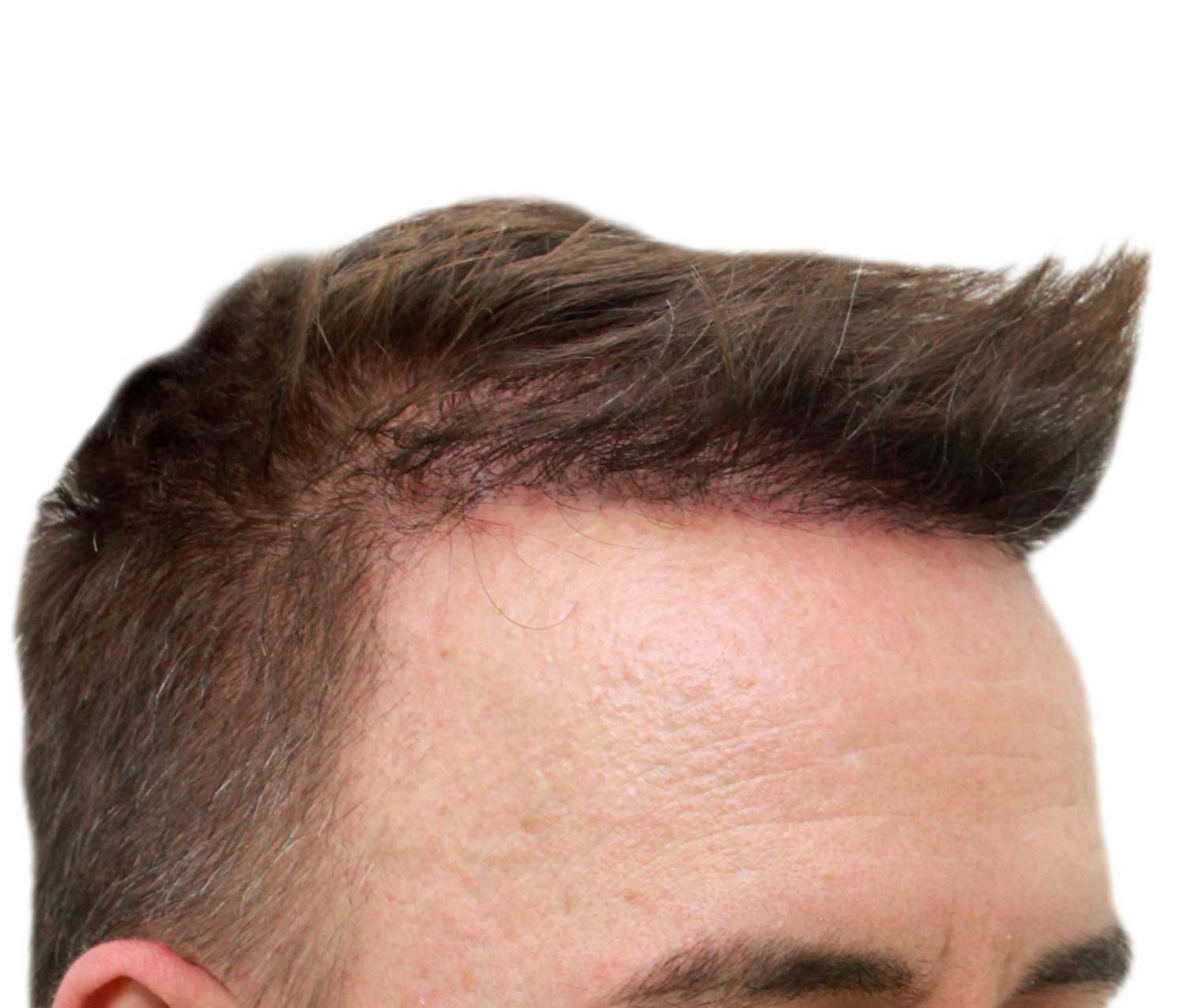 After hair restoration | Real patient, results may vary per individual