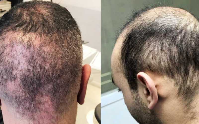 Why Hair Transplant Cost Is Not the Most Important Factor