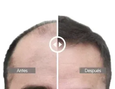 Antes y después de paciente real | Trasplante Capilar