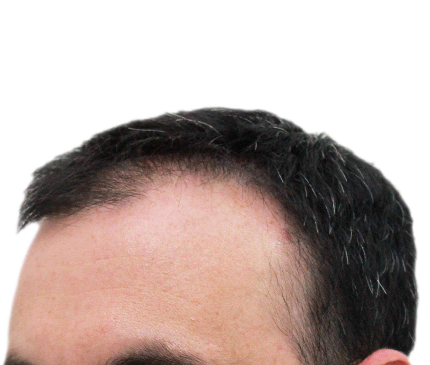 Before hair restoration | Real patient, results may vary per individual