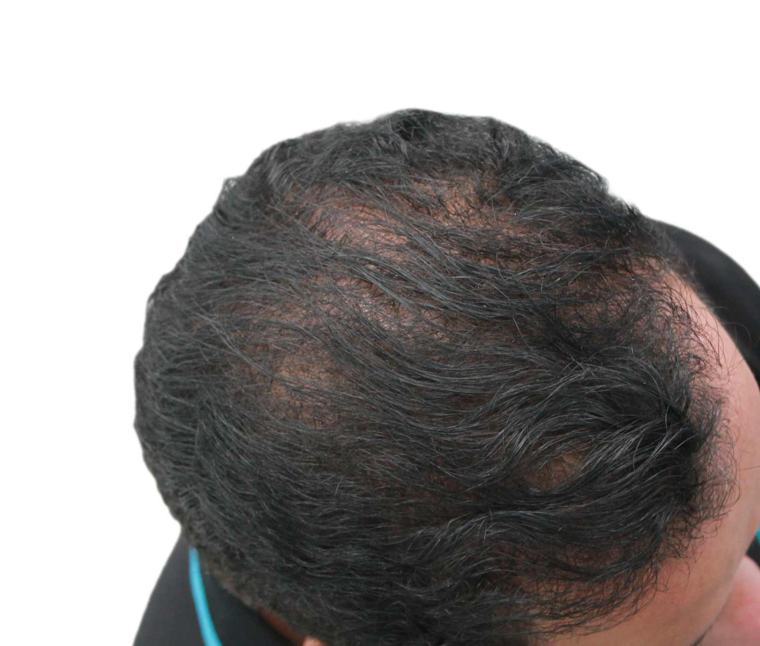 After hair restoration | Real patient, results may vary per individual