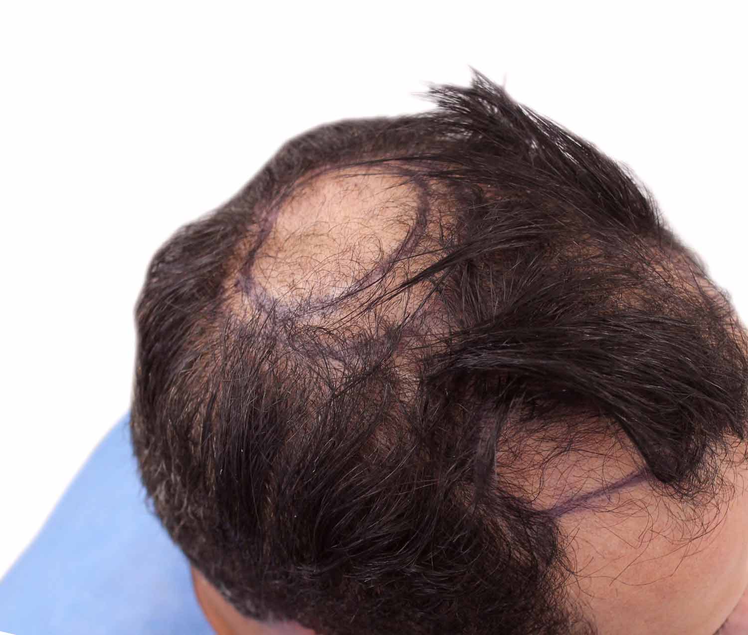 Before hair restoration | Real patient, results may vary per individual