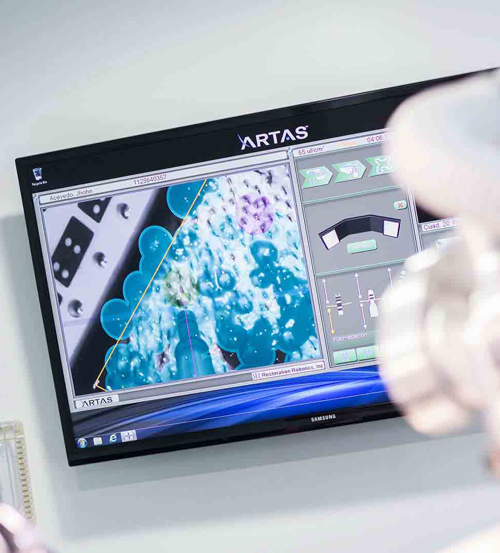 ARTAS | Tecnología de vanguardia en trasplante capilar