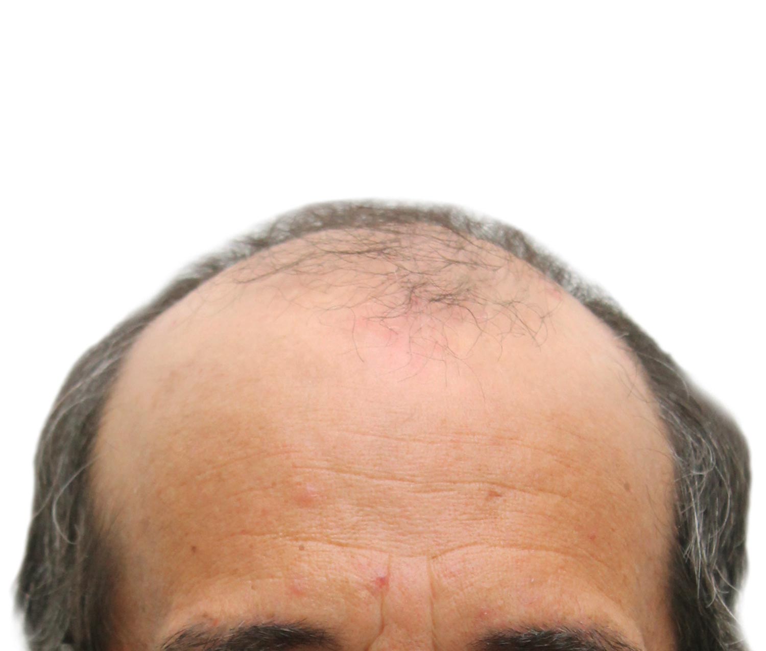 Antes del injerto de cabello | Paciente real. Los resultados individuales pueden variar.