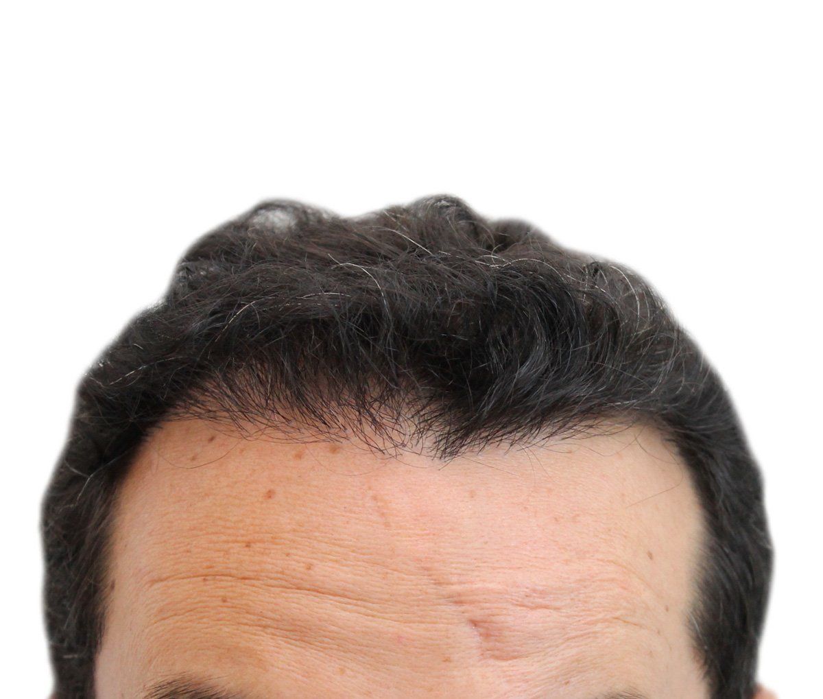 a close up of a man 's forehead with a white background .