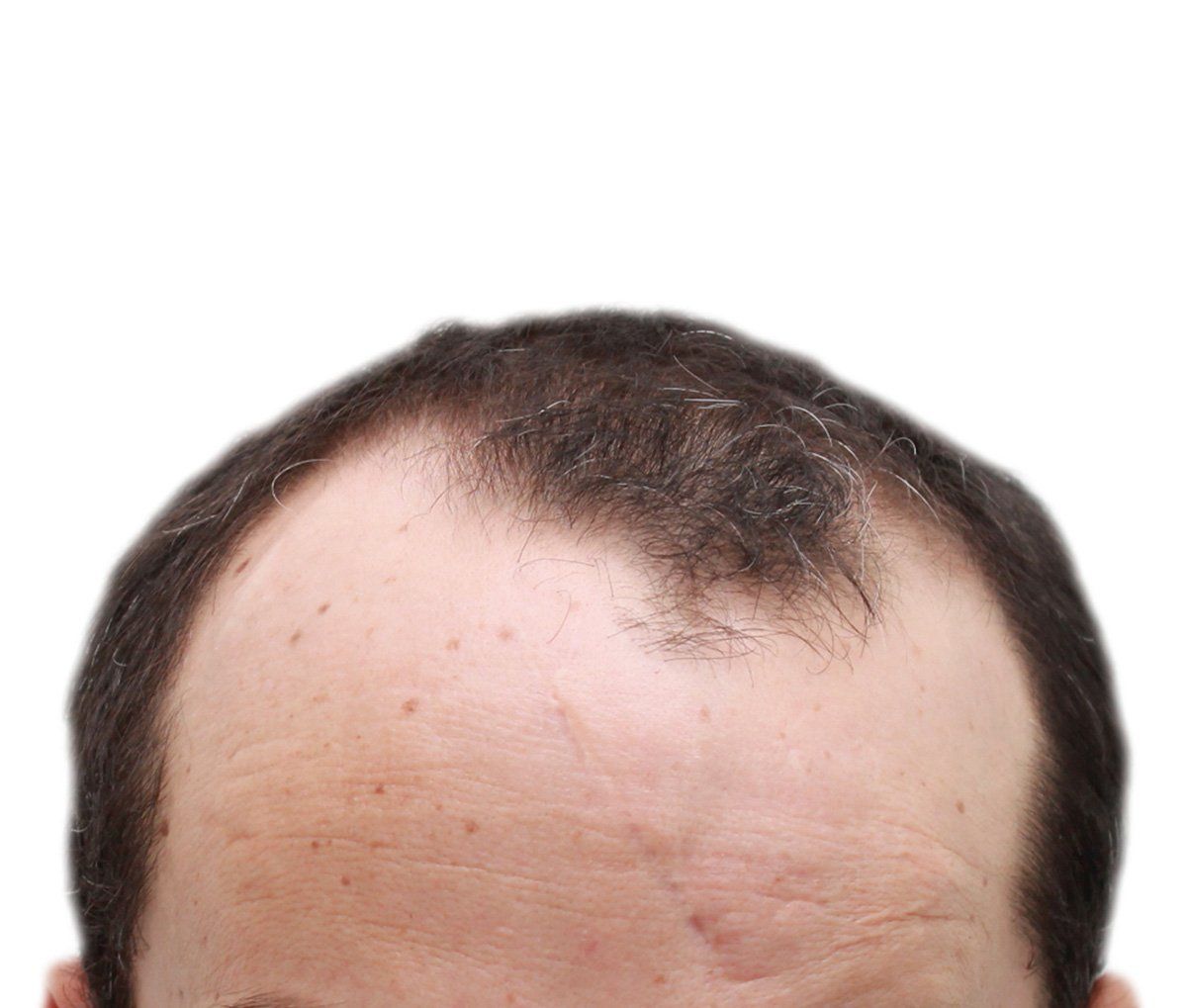a close up of a man 's bald head on a white background .