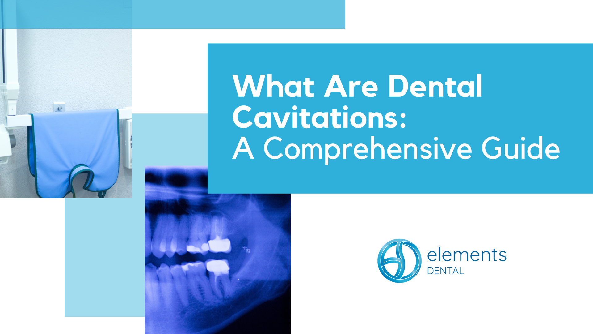 What are dental cavitations : a comprehensive guide