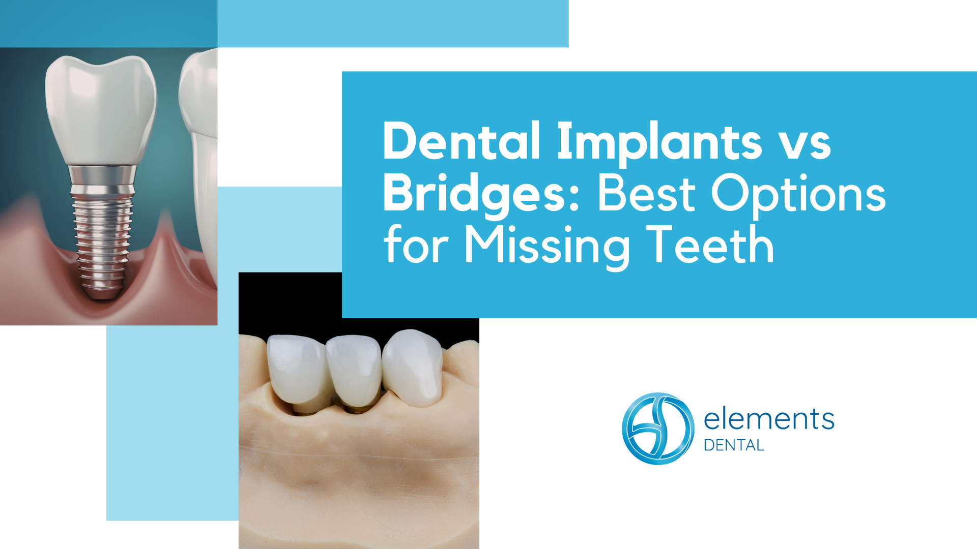 An infographic comparing dental implants and bridges with a logo for Elements Dental on a blue background.