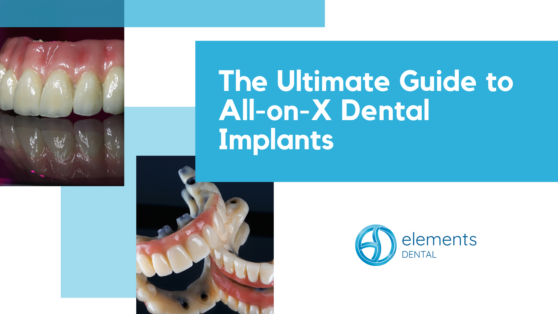 The ultimate guide to all-on-x dental implants by elements dental