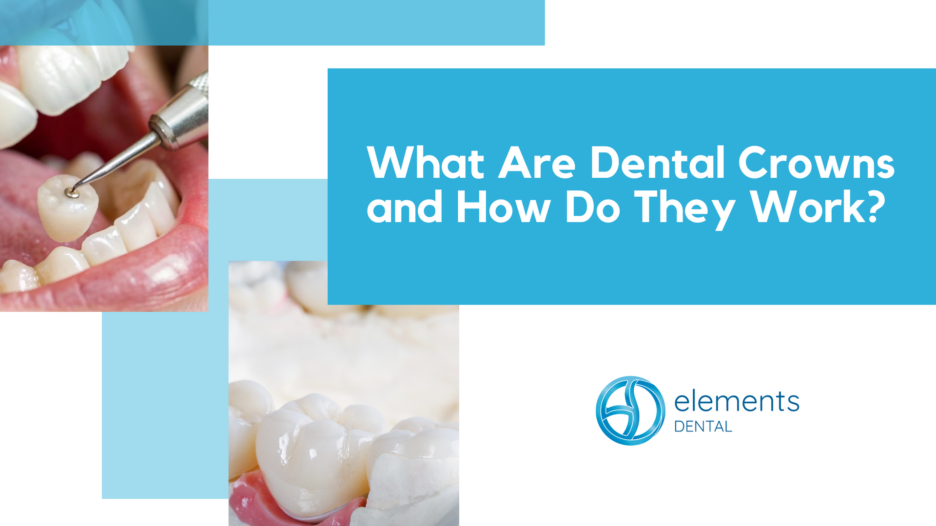 Dental crowns procedure: a tooth being worked on by dentist, crown, and text on a blue background.