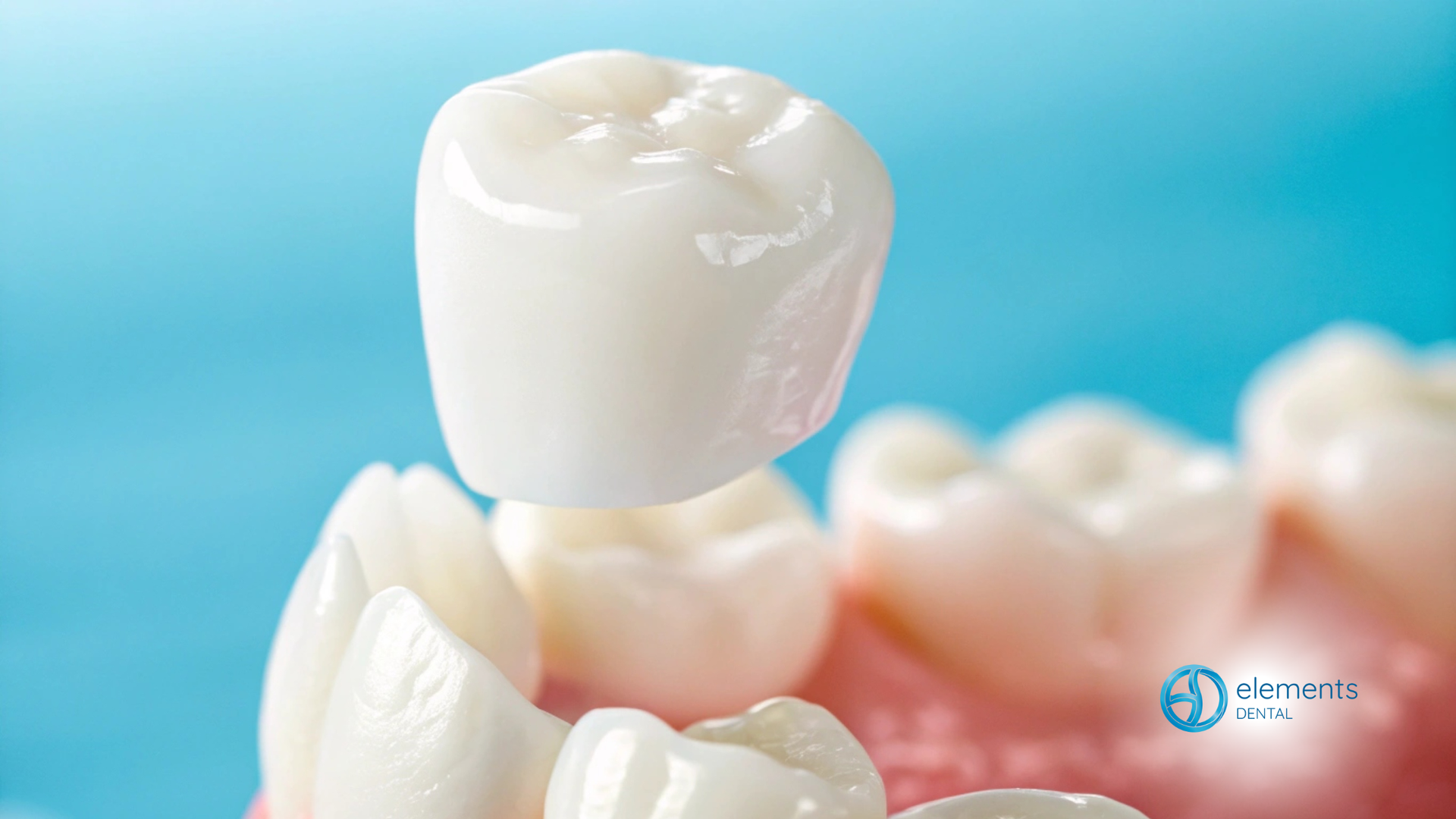 Dental crown being placed over a prepared tooth, against a light blue backdrop.