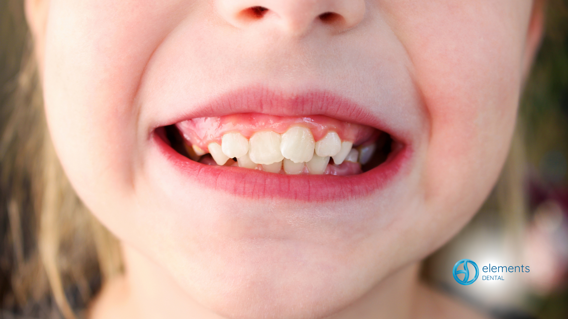 A close up of a little girl 's mouth with her teeth showing.