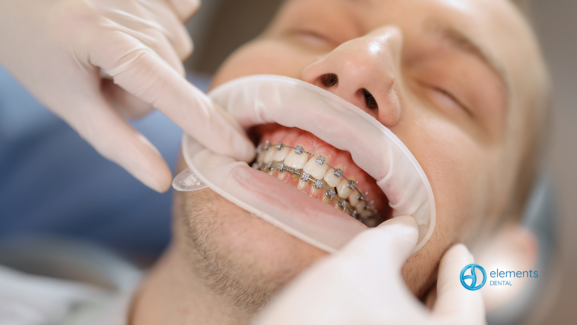 A man with braces is getting his teeth examined by a dentist.