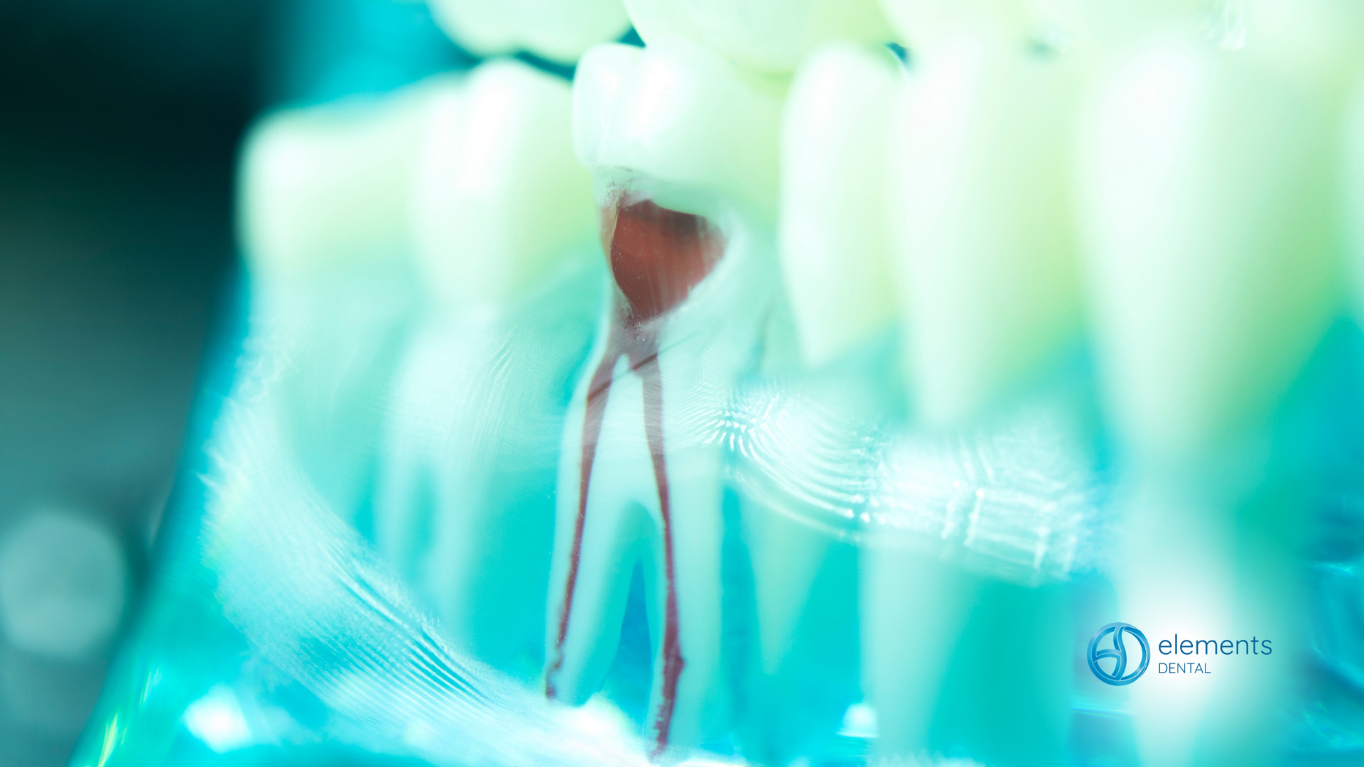 A close up of a tooth with a hole in it.