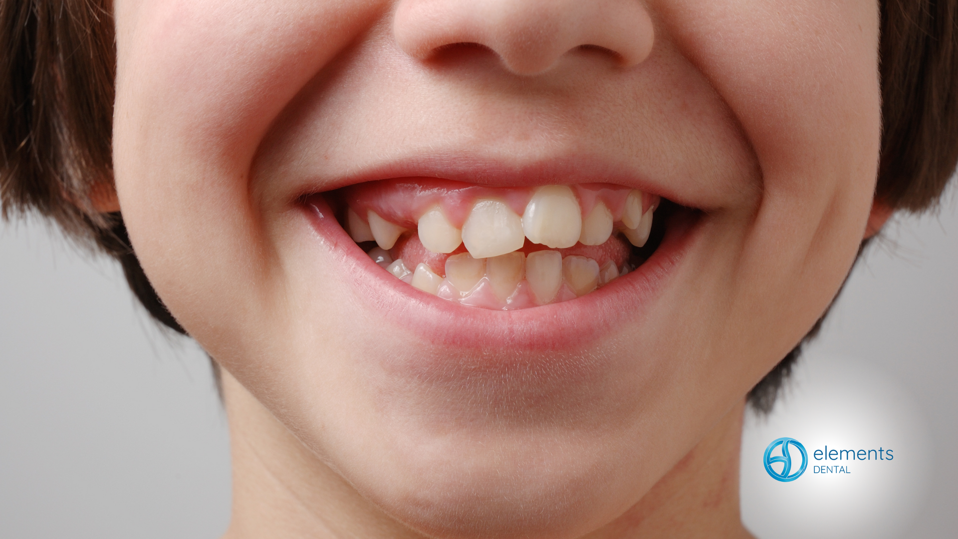 A close up of a child 's mouth with missing teeth.