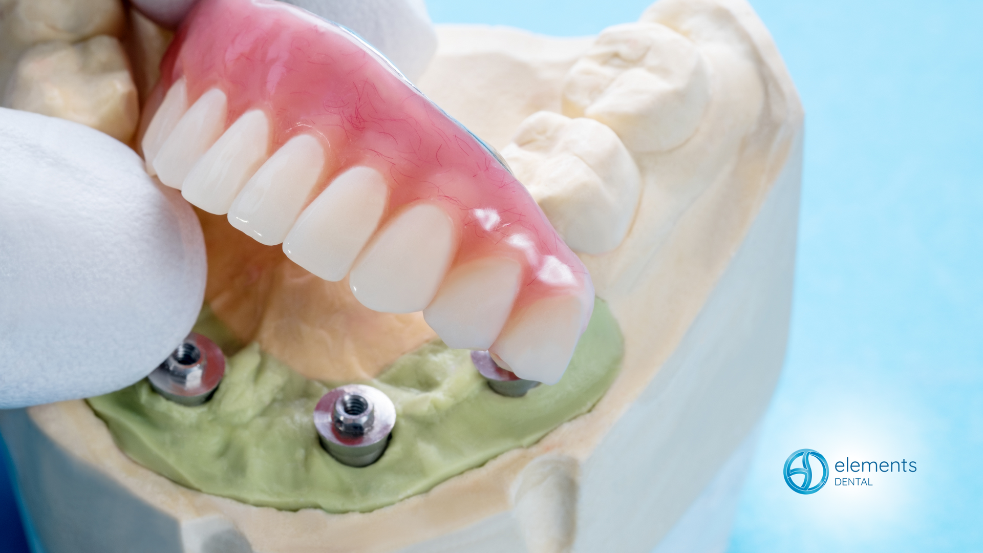 A close up of a denture on a model of a person 's teeth.