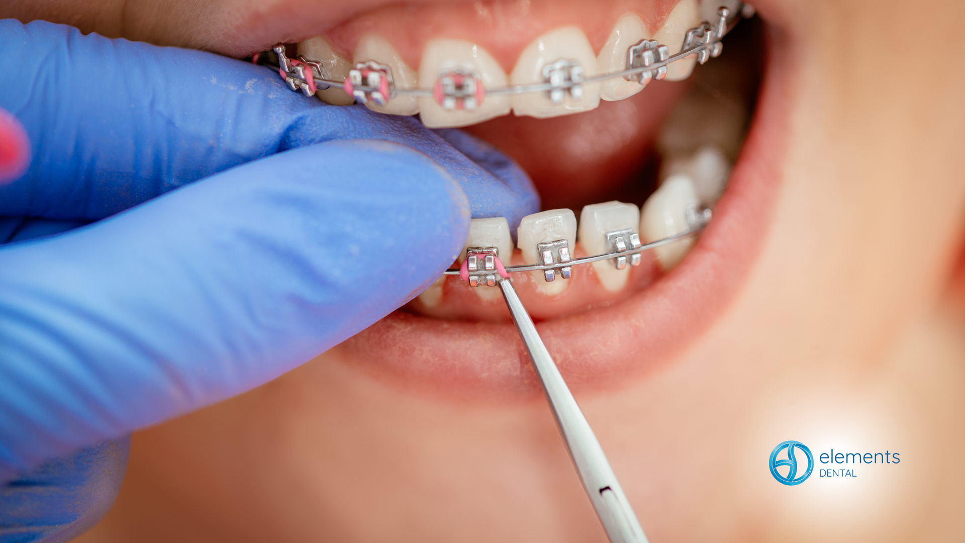 A close up of a person 's teeth with braces being cleaned by a dentist.