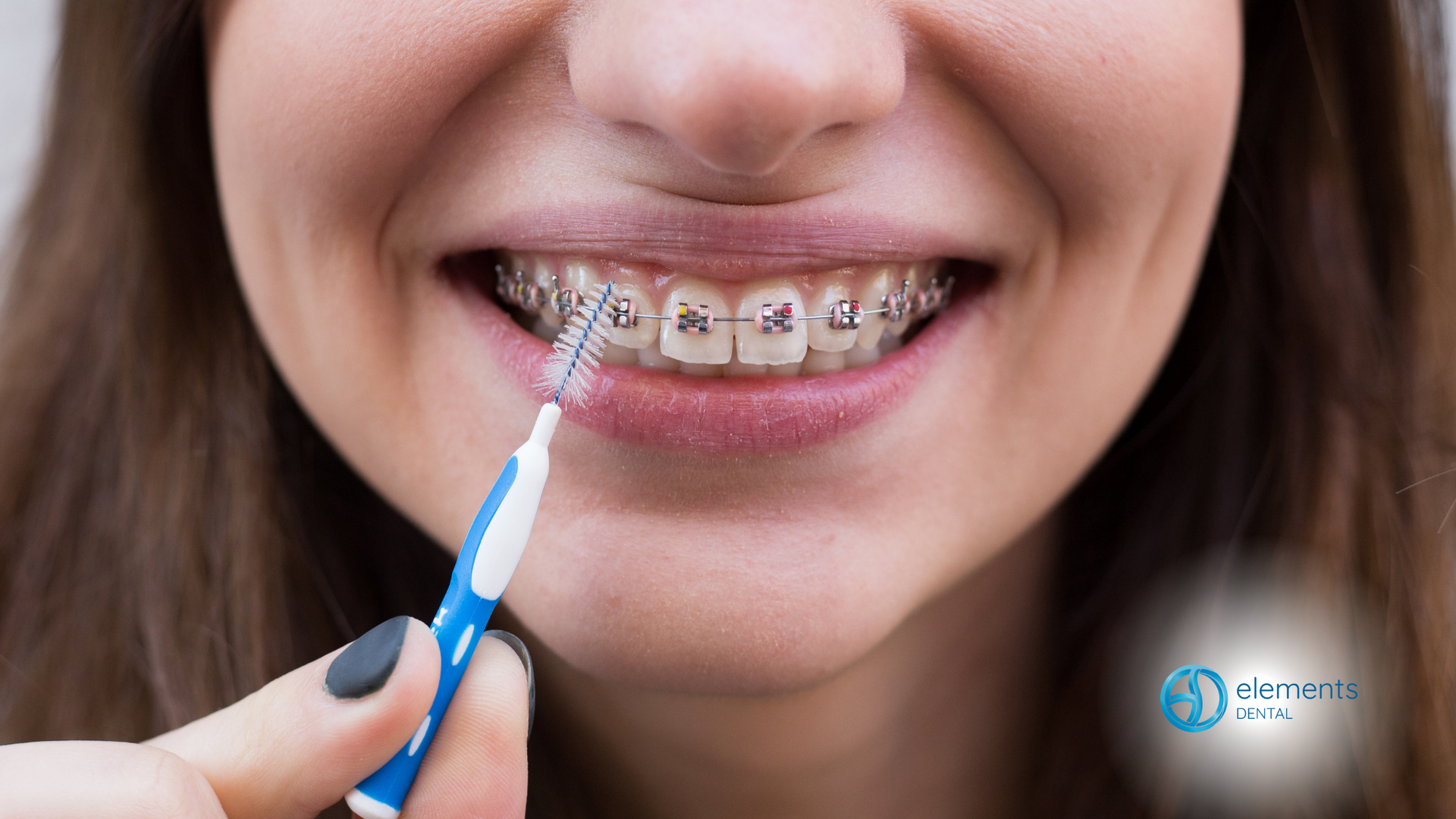 A woman with braces is cleaning her teeth with an interdental brush.