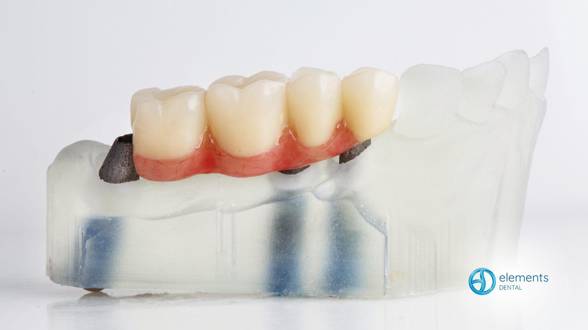 A model of a dental bridge on a white surface.