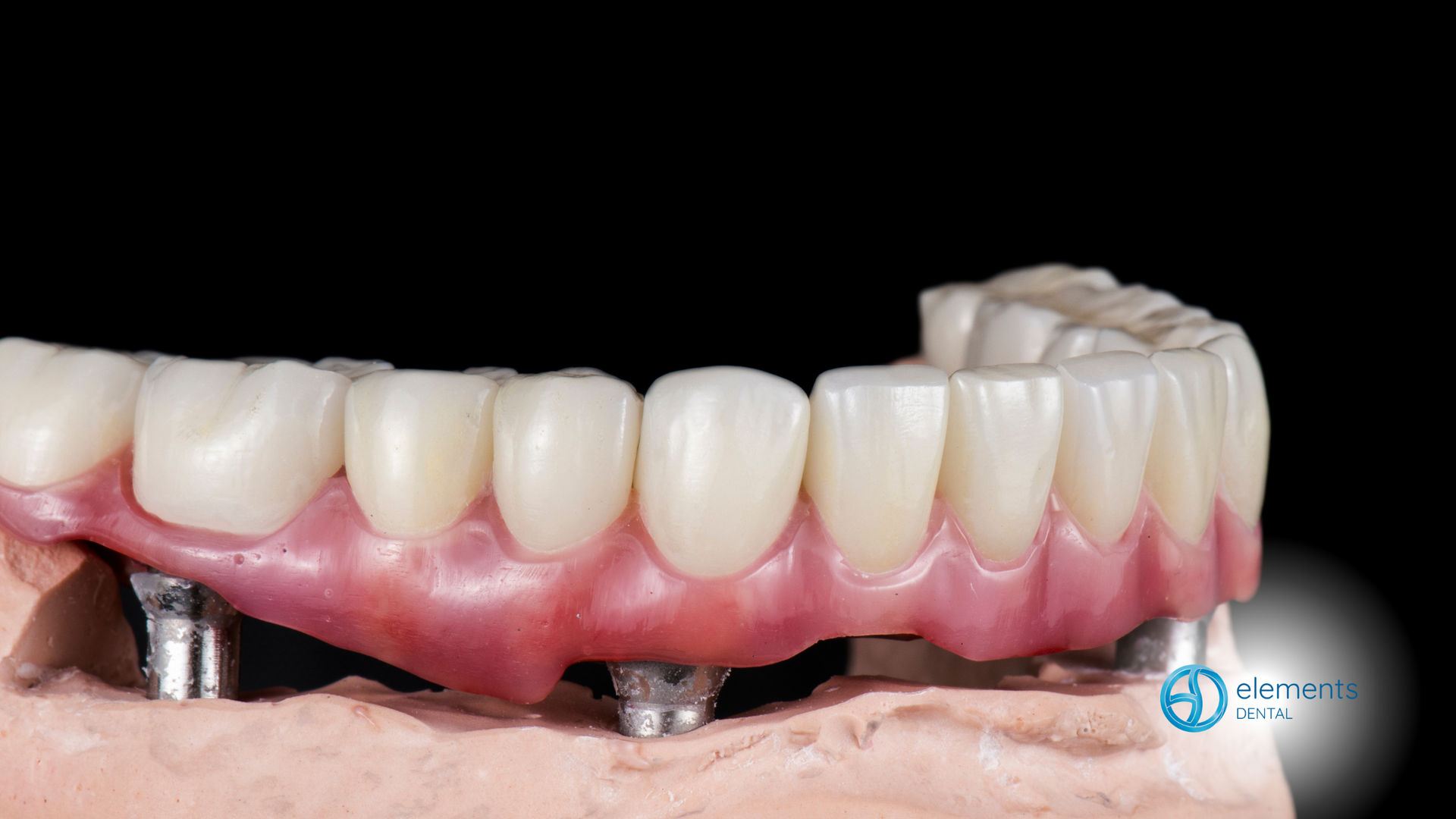 A close up of a denture on a model of a person 's teeth.