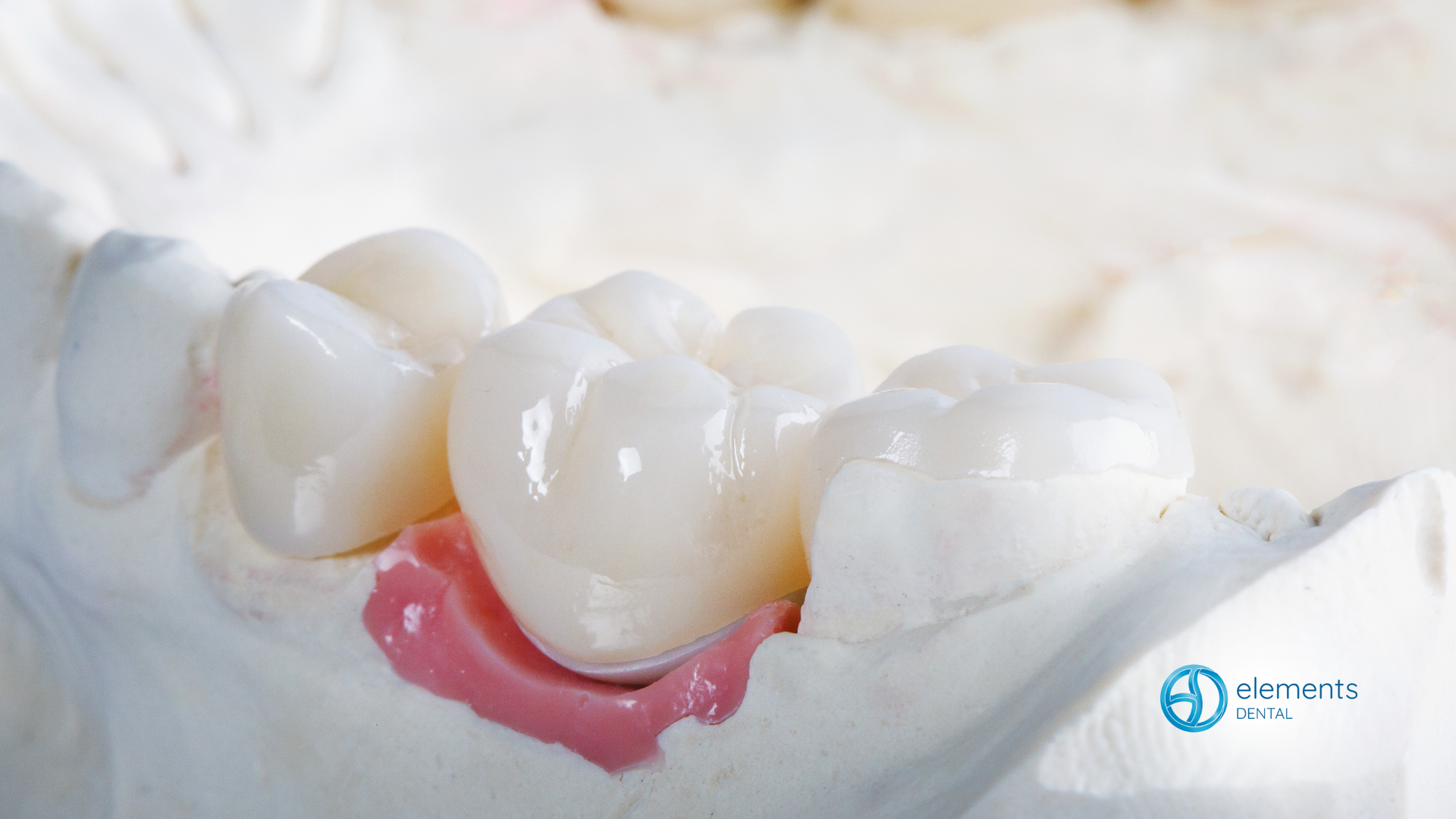 A close up of a model of a tooth with a crown on it.
