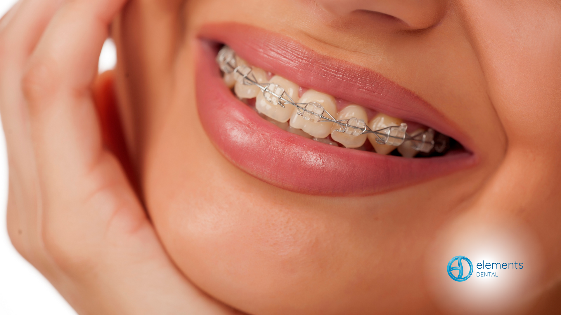 A close up of a woman 's mouth with braces on her teeth.