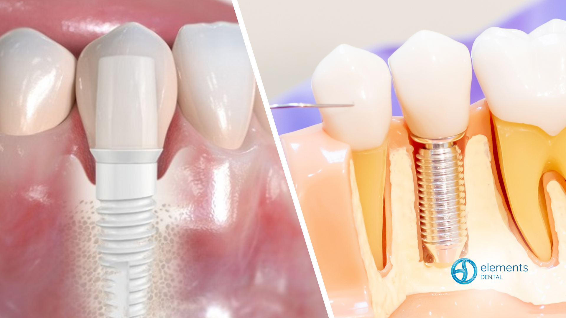 A picture of a dental implant and a picture of a dental implant in a person 's mouth.