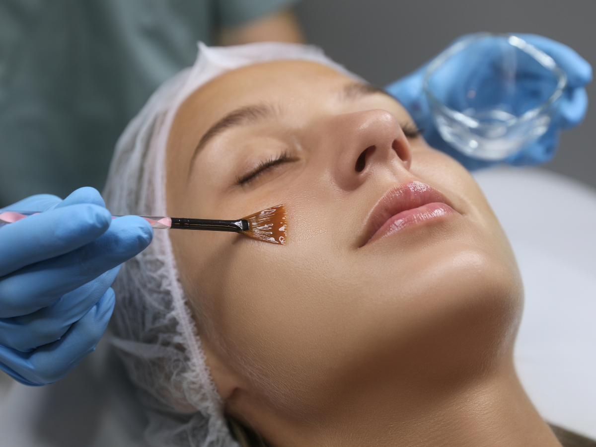 Chemical Peel