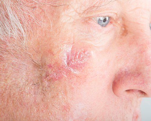 Mohs On Man Face — Redlands, CA — Aesthetic Skin And Laser