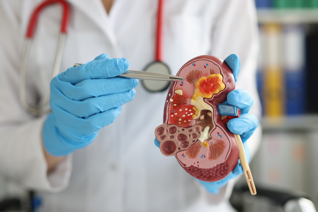 A doctor is holding a model of a kidney with a scalpel.