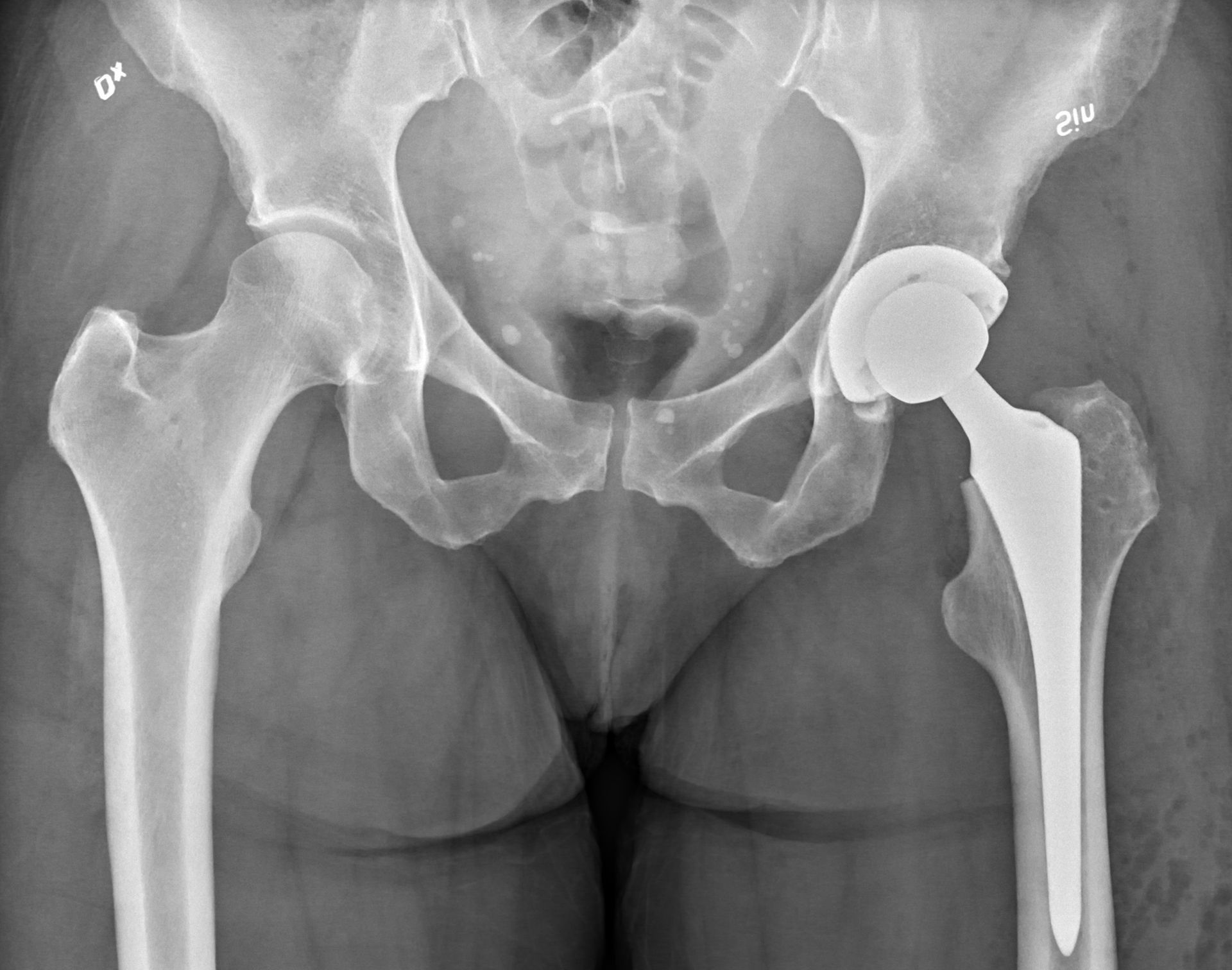 Prótese de quadril. Quanto custa a cirurgia de prótese de quadril