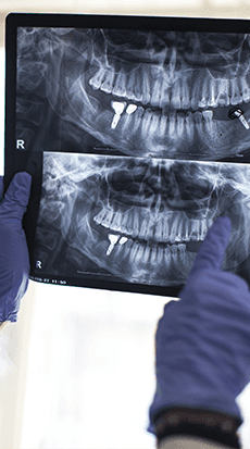 Ponte dentale - Dott.Marco Dormi Odontoiatra a Terni