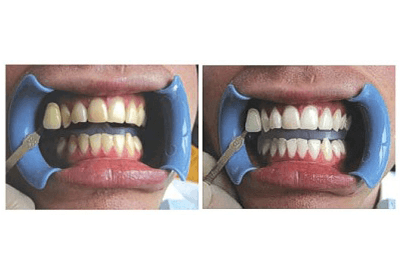 sbiancamento denti prima e dopo