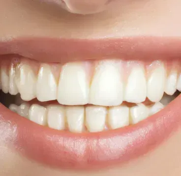 banana-river-dental-teeth-whitening-image