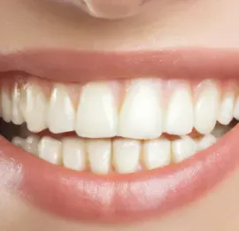 banana-river-dental-teeth-whitening-image