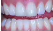 After Teeth Whitening — Clinton, MD — Hamam & Lamb DDS PA