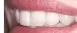 After Veneers — Clinton, MD — Hamam & Lamb DDS PA