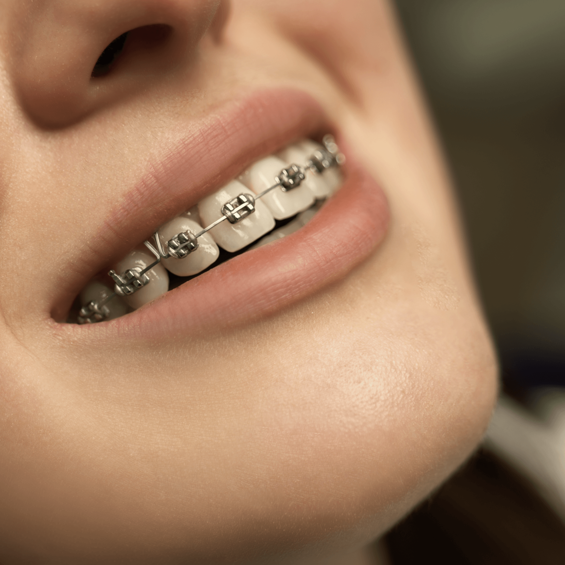 Aparelho Ortodôntico