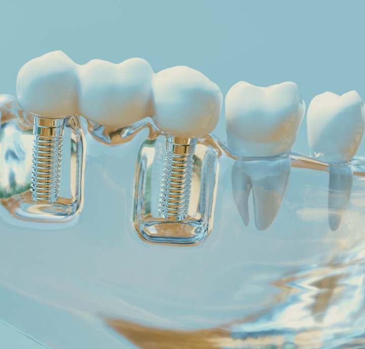 Implante Dental