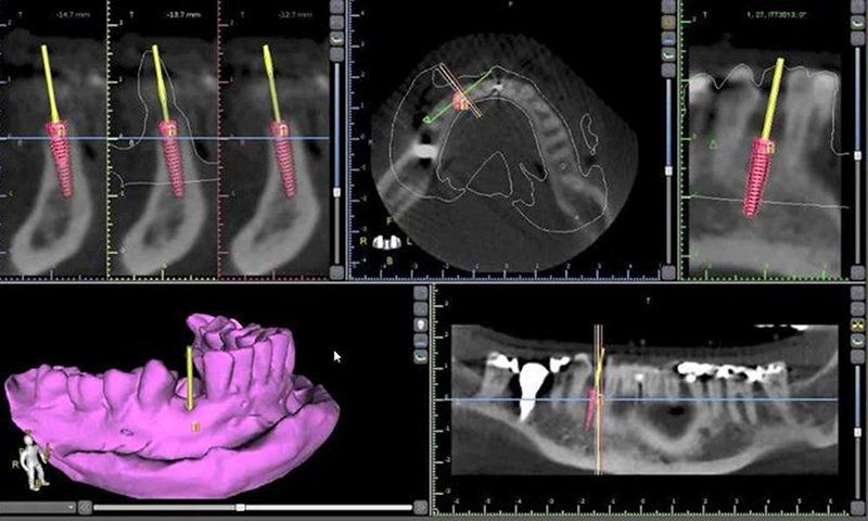 Tomografia Computadorizada Cone Beam