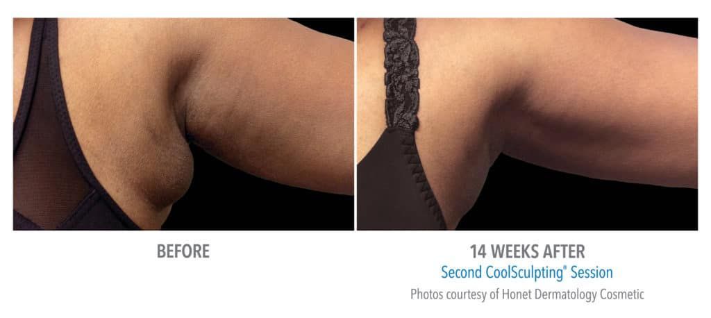 A before and after photo of a woman 's arm